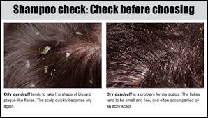 It might cause your scalp to feel dry and itchy, which can lead you to scratch your scalp. Alpecin What Causes Dandruff