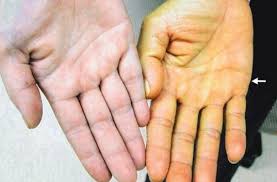 Hepatitis b is a viral infection that causes liver inflammation and damage. Gejala Hepatitis Beda Dengan Flu Biasa Yuk Pahami Lebih Lanjut