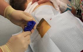 Image result for Bone Marrow Exam