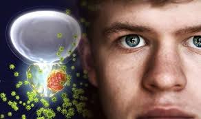 Other symptoms of advanced prostate cancer depend on where it has spread and how big the tumors are: Prostate Cancer Symptoms Jaundice In The Eyes Could Be Sign Of Advanced Cancer Express Co Uk