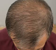 Protecting your scalp in summer. Hair Loss In Men Boss Clinic