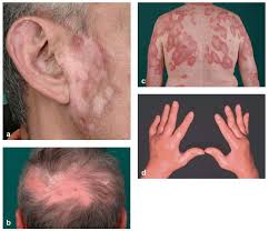 Herpes sendiri termasuk salah satu jenis penyakit yang menular yang dapat menyerang permukaan kulit seseorang. Kriteria Diagnosis Sle Systemic Lupus Erythematosus Kedokteran Caiherang