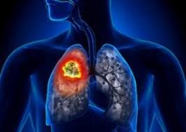 Small cell carcinoma of the lung, also small cell lung carcinoma (abbreviated sclc) is an aggressive malignant tumour of the lung. Non Small Cell Lung Cancer Nsclc Trial In Pharma
