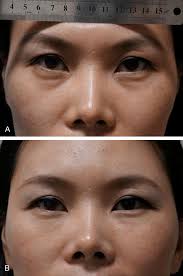 Original Article Transconjunctival fat reposition with septal reset for the  treatment of tear trough