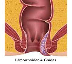 Wann es um den hintern geht, musst auf die seite liegen. Proktologie Vielleicht Unangenehm Aber Sicher Ist Sicher