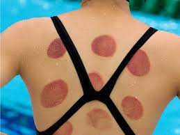 While cupping hit the mainstream thanks to olympic athletes, the practice has a religious history in islam. Cupping Therapy At The Olympics