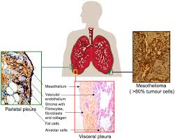 There are four different types of mesothelioma cancer, depending on the tumor location. Schematic Presentation Of Mesothelioma The Parietal And Visceral Download Scientific Diagram