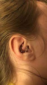 Anyone Have Any Experience With Keloids Forming From Cartilage Piercing I Got My Piercing Done About A Month Ago And These Cartilage Piercing Piercing Keloid
