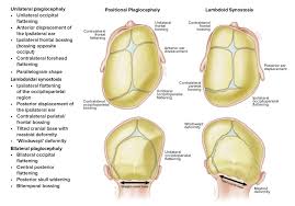 Image result for Positional Head Deformity