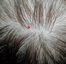 Diese art von hauttrauma kann zu einer verschlechterung des zustands und einer tieferen infektion führen. Roter Pickel Auf Der Kopfhaut Angst Vor Hautkrebs