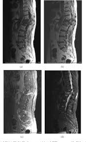 Pdf Imaging Findings And Evaluation Of Metabolic Bone Disease Semantic Scholar