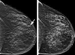 Cancers may be seen as masses (like a ball, but usually with an irregular shape), areas of asymmetry that resemble normal tissue, calcifications (white specks), and/or areas of architectural distortion (imagine the puckering caused by pulling a thread in a piece of fabric). 3d Mammography Creates More Precise Images To Detect Breast Cancer Shots Health News Npr