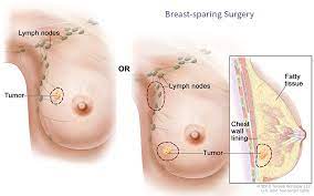 There are five stages of breast cancer, ranging from 0 to iv. Breast Cancer Treatment Options Virginia Oncology