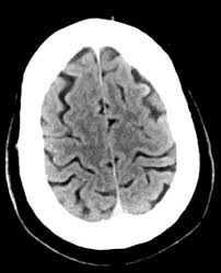 Computed tomography (ct) scanning is used commonly in medicine today. Computertomographie Ct Bei Neurologischen Storungen Neurologische Krankheiten Msd Manual Profi Ausgabe