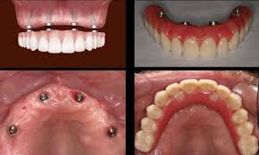Immediate dentures minimize the swelling and bleeding that occur when all of your teeth are extracted. Immediate Dentures Delhi India Cost Of Same Day Dentures Delhi India