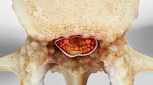 La espondilolistesis, puede causar estenosis espinal; Estenosis Espinal Traumatologia Clinica Uandes