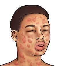Maybe 30 minutes after taking one tablet, skin hives/rashes were forming all over my body. Anaphylactic Shock News Dentagama