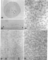 Image result for Rh Sensitization
