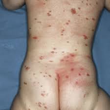 Image result for Urticaria pigmentosa children