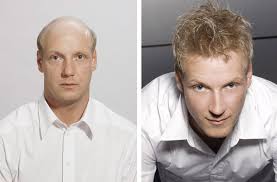 Man weaves, more formally referred to as cranial prosthesis, hair replacement units or hair systems, are a nonsurgical procedure to help men who've lost their hair — be it through just balding or. Sensigraft Men S Non Surgical Hair Replacement Transitions Hair