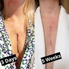 Cristen S Heart Surgery Incision Healing After 5 Weeks Heart Surgery Surgery Healing