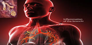 Image result for Acute Bronchitis