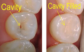 Depending on how big is the cavity, the drilling takes between 5 and 15 minutes. Tooth Filling Procedure Cost Cavity Filling Types Nearby Dental