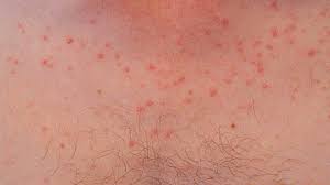 The age of the patients ranged from 18 to 45 years. Pityrosporum Folliculitis Natural Treatment Face And More