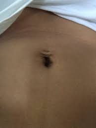 My Naval Piercing Is Saggy After Pregnancy How Could I Fix This Photo