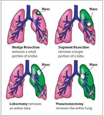 Pin On Lungs