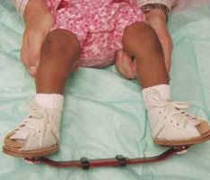 Treatment should begin a week or two after birth. Club Foot Treatment