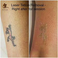 Tattoos are comprised of a diverse range of colors and particle sizes, making their removal a formidable challenge. 2 Day Laser Tattoo Removal Training Course Minnesota Brow Lash Studio Academy