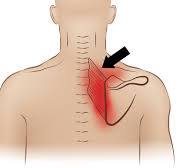 How to INSTANTLY Relieve Rhomboid Pain