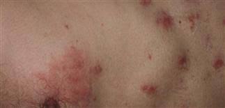 Image result for Rhus Dermatitis