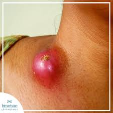 Image result for Extrapulmonary Tuberculosis