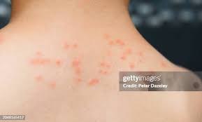 Image result for Trombicula autumnalis bites