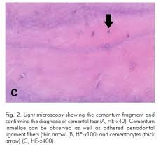 Cemental tear is an uncommon type of root fracture, which is associated with periodontal tissue destruction (1). Scielo Brasil Cemental Tear A Case Report With Nonsurgical Periodontal Therapy Cemental Tear A Case Report With Nonsurgical Periodontal Therapy