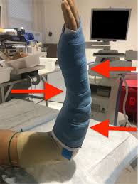 Image result for Short Arm Cast