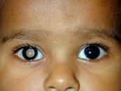 What Is Retinoblastoma? | OBN