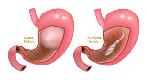 هل تعرف أضرار بالون المعدة ويب طب