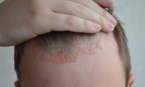 Ngoài ra, các chất dinh dưỡng trong giấm táo cũng có tác dụng nuôi dưỡng da đầu. Trá»‹ Gau Dyvi Dáº§u Gá»™i Ä'áº·c Trá»‹ Gau Náº¥m Da Ä'áº§u