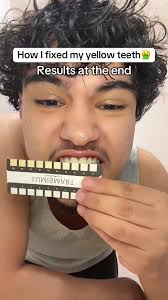 Lumismart Whitening Strips Honest Review