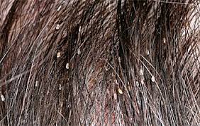 Check your own hair for lice. How To Check For Lice And Nits 3 Step Video Procedure