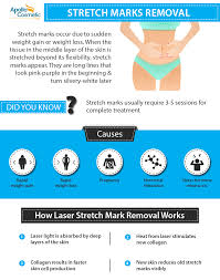 Treatment seems to have little effect on mature stretch marks. Laser Stretch Marks Removal In Chennai Apollo Cosmetic Clinics