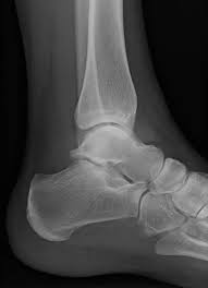 Image result for Ankle XRay
