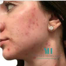 Microneedling
