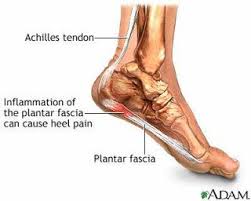Physical Therapy Database Plantar Fasciitis Heel Spur Chronic Plantar Fasciitis What Is Plantar Fasciitis Achilles Tendonitis