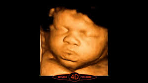 Browse 10,202 ultrasound stock photos and images available, or search for ultrasound baby or pregnancy. What Is 4d Ultrasound Scan Youtube