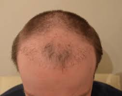 Jetzt kostenlose beratung bei der my es liegt auf der hand, dass sich eine haarverpflanzung im vergleich zu einem toupet als vorteilhaft erweist. Schlechte Verpfuschte Haartransplantation Mit Negativer Erfahrung Hairforlife
