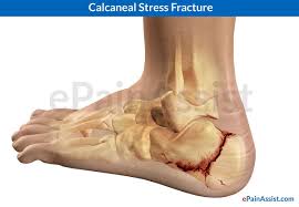 Calcaneal Stress Fracture Stress Fracture Fracture Symptoms Stress Symptoms